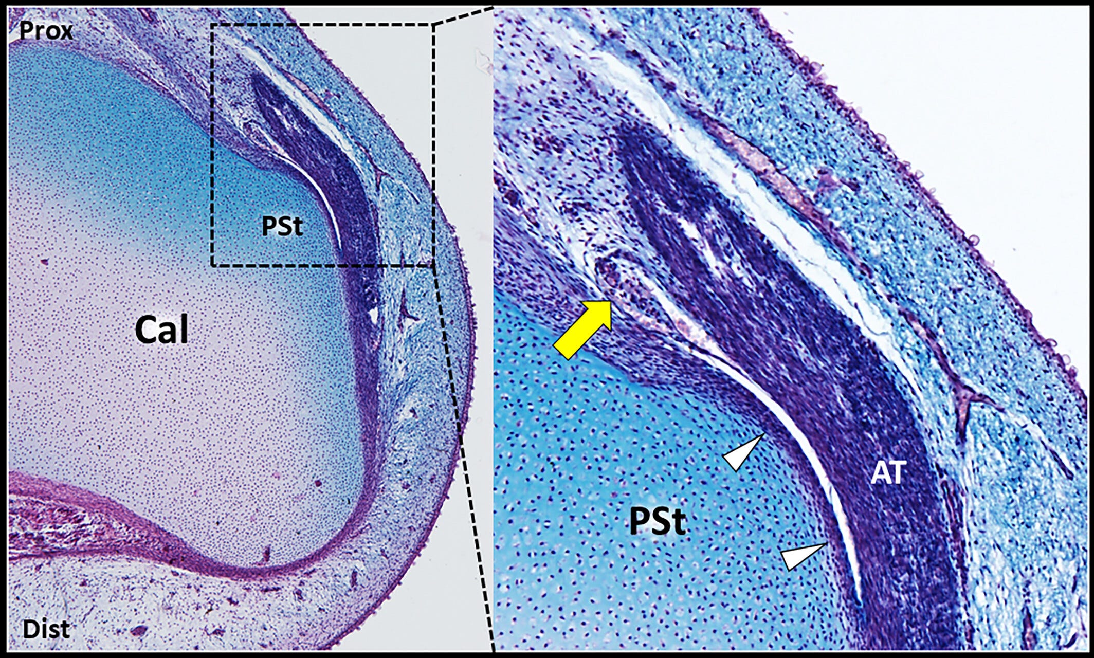 Bursa retrocalcanea 2 Tempo Formacion ecografia.jpg